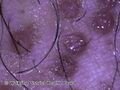 Lichen amyloidosis (DermNet NZ lichen-amyloidosis-10).jpg