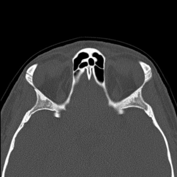 File:Nasal septal perforation (Radiopaedia 25030-25289 Axial bone window 52).jpg