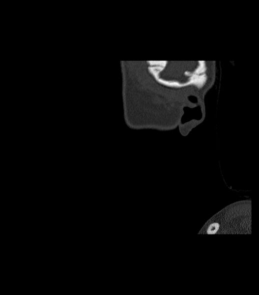 File:Nasoorbitoethmoid fracture (Radiopaedia 90044-107205 Sagittal bone window 136).jpg