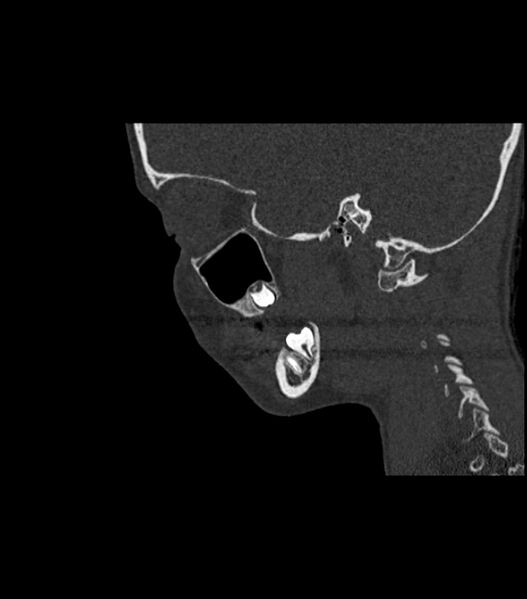 File:Nasoorbitoethmoid fracture (Radiopaedia 90044-107205 Sagittal bone window 49).jpg