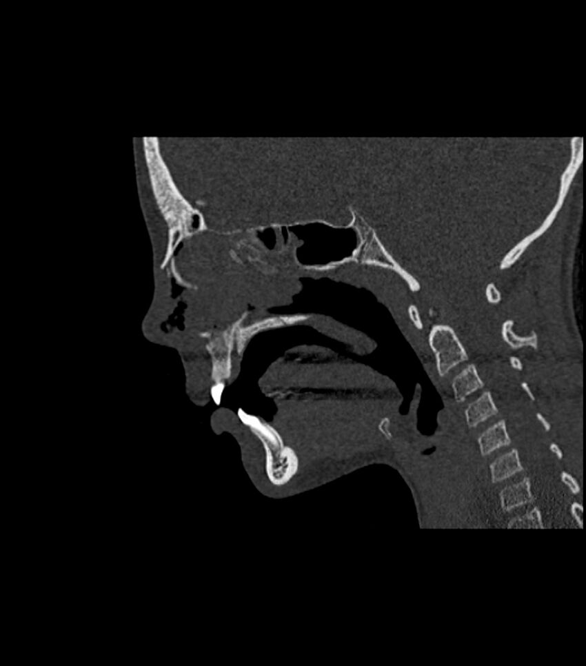 Nasoorbitoethmoid fracture (Radiopaedia 90044-107205 Sagittal bone window 77).jpg