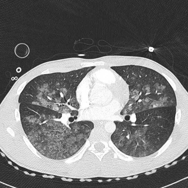 File:Near drowning (pulmonary edema) (Radiopaedia 24685-24958 lung window 34).jpg