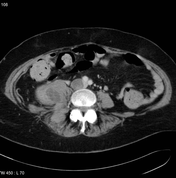 File:Nerve sheath tumor - malignant - sacrum (Radiopaedia 5219-6987 A 1).jpg