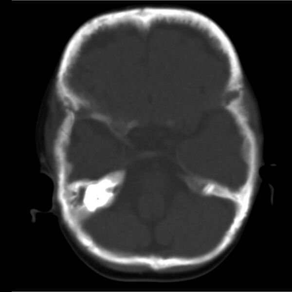 File:Neuroblastoma with skull metastases (Radiopaedia 30326-30958 Axial bone window 4).jpg