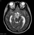 Neurofibromatosis type 2 - cranial and spinal involvement (Radiopaedia 5351-7111 Axial T2 10).jpg