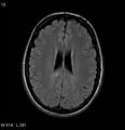 Neurosarcoidosis (Radiopaedia 10930-17204 Axial FLAIR 13).jpg