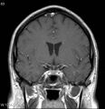 Neurosarcoidosis (Radiopaedia 10930-17204 Coronal T1 C+ 7).jpg
