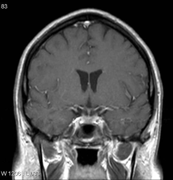File:Neurosarcoidosis (Radiopaedia 10930-17204 Coronal T1 C+ 7).jpg