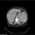 Non-Hodgkin lymphoma (Radiopaedia 27492-27690 B 21).jpg