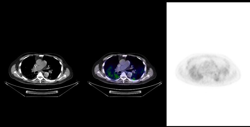 File:Non-Hodgkin lymphoma involving seminal vesicles with development of interstitial pneumonitis during Rituximab therapy (Radiopaedia 32703-33761 ax CT Fus PET 16).jpg