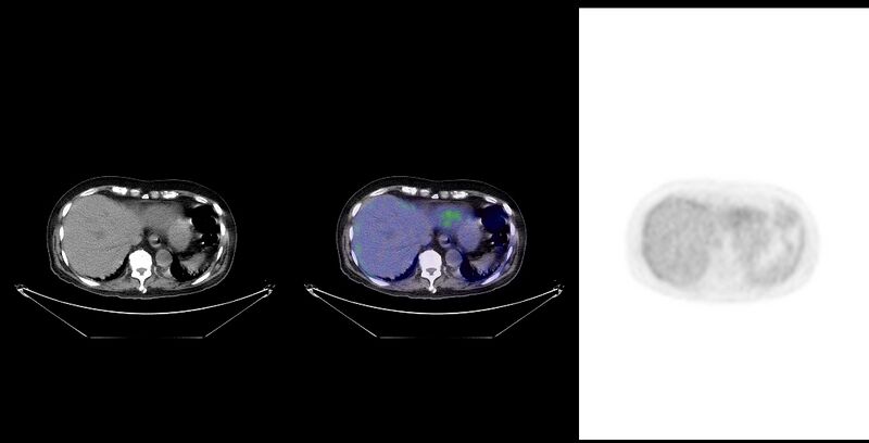File:Non-Hodgkin lymphoma involving seminal vesicles with development of interstitial pneumonitis during Rituximab therapy (Radiopaedia 32703-33761 ax CT Fus PET 26).jpg