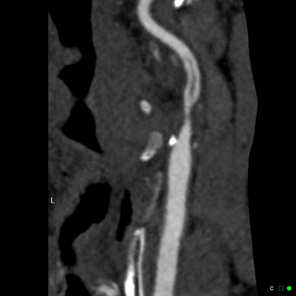 File:Non-occlusive intraluminal internal carotid artery thrombus (Radiopaedia 37751-39658 A 41).jpg