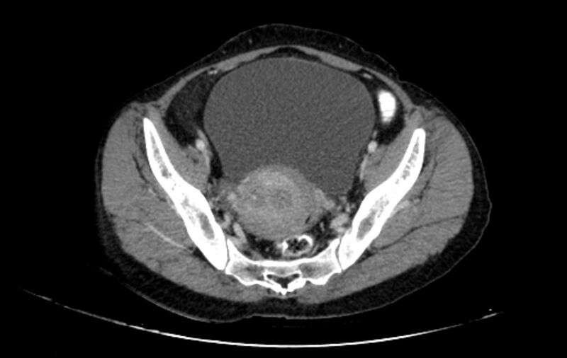 File:Non-puerperal uterine inversion (Radiopaedia 78343-91094 A 12).jpg