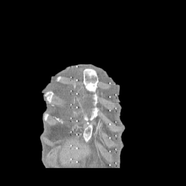 File:Non hodgkin lymphoma of the mediastinum (Radiopaedia 20814-20729 C 2).jpg