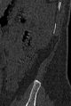 Normal CT lumbar spine (Radiopaedia 53981-60118 Sagittal bone window 105).jpg