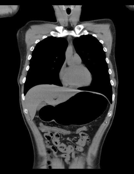 File:Normal CT virtual gastroscopy (Radiopaedia 29960-30501 E 16).jpg