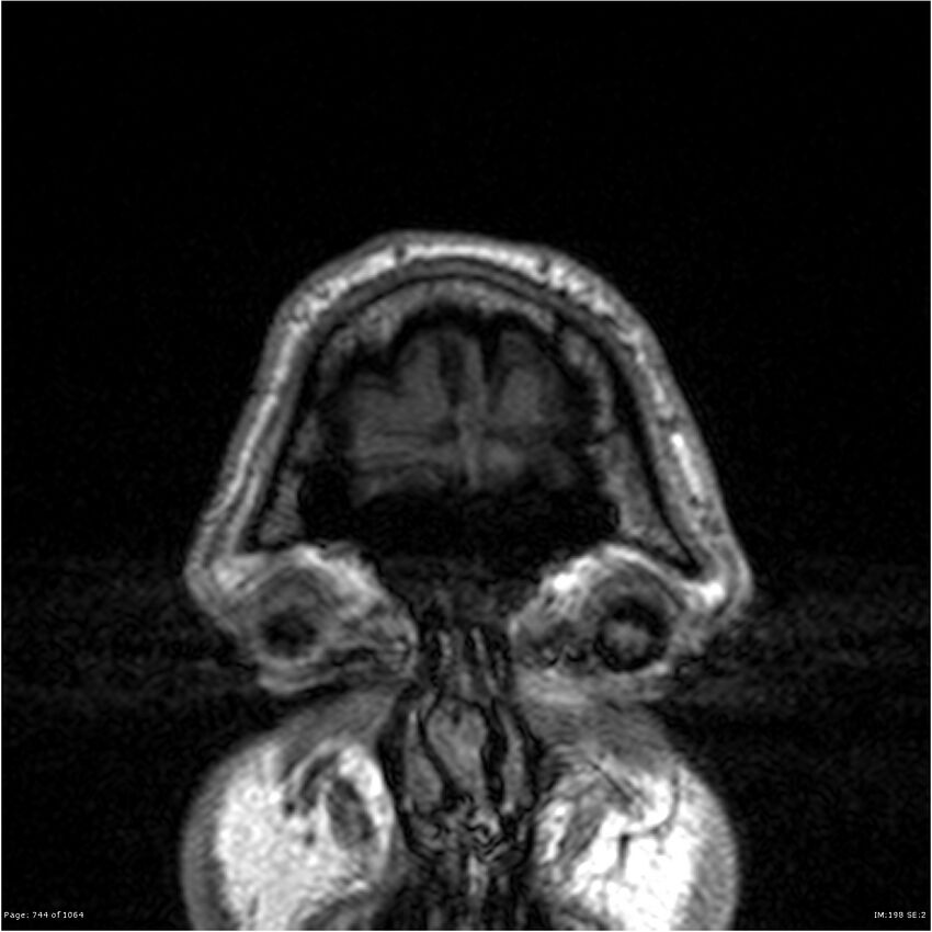 Normal brain MRI (non-focal epilepsy protocol) (Radiopaedia 38571-40700 Coronal T1 98).jpg