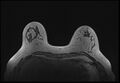Normal breast MRI - dense breasts (Radiopaedia 80454-93850 Axial T1 60).jpg