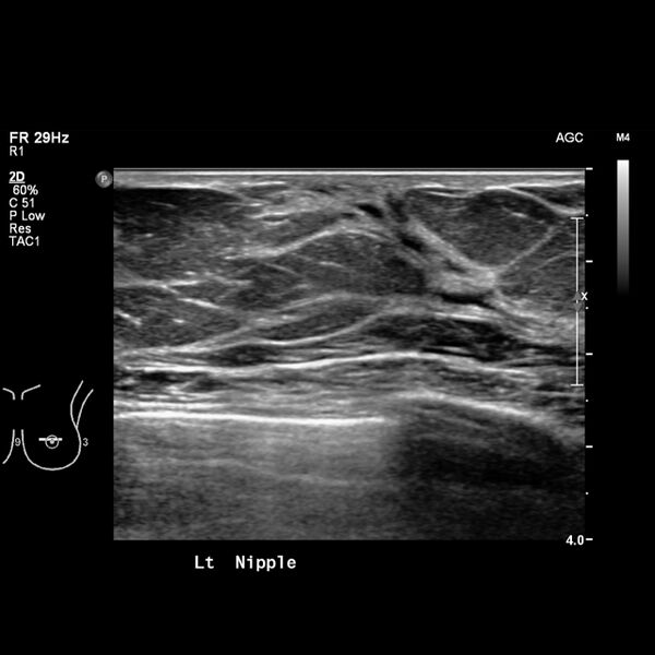 File:Normal breast mammography (tomosynthesis) and ultrasound (Radiopaedia 65325-74354 Left breast 13).jpeg