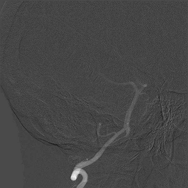 File:Normal cerebral angiogram (four vessel DSA) (Radiopaedia 41708-44649 O 6).png