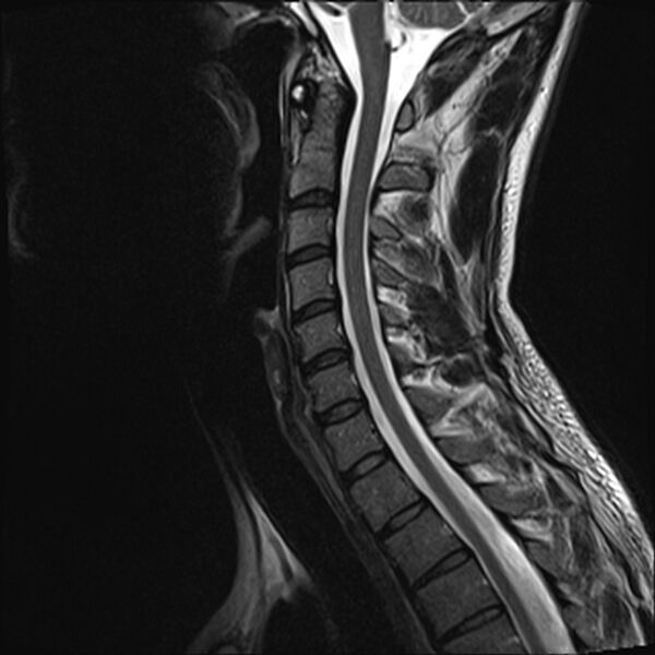 File:Normal cervical spine MRI (Radiopaedia 38418-40496 Sagittal T2 7).jpg