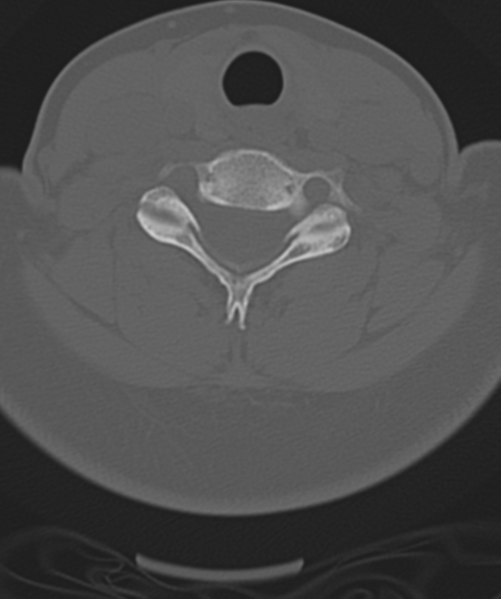 File:Normal cervical spine MRI (including Dixon) (Radiopaedia 42762-45926 Axial bone window 40).png