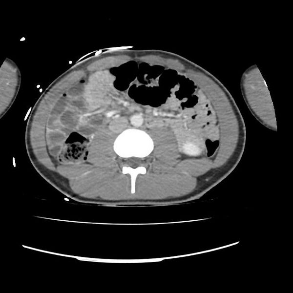 File:Normal dual-phase trauma CT chest,abdomen and pelvis (Radiopaedia 48092-52899 A 75).jpg