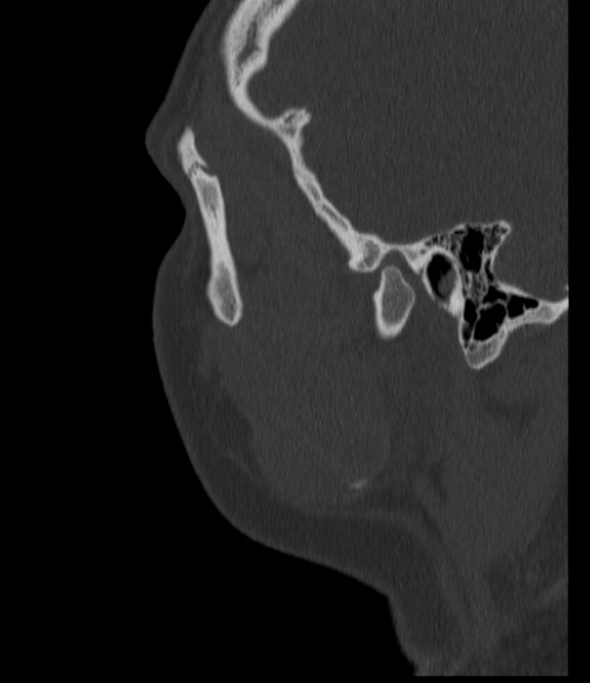 Normal facial bone CT (Radiopaedia 88742-105476 Sagittal bone window 33).jpg