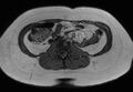Normal liver MRI with Gadolinium (Radiopaedia 58913-66163 B 4).jpg