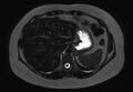 Normal liver MRI with Gadolinium (Radiopaedia 58913-66163 E 25).jpg