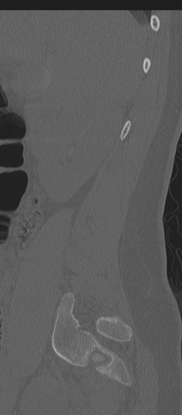 File:Normal lumbosacral CT (Radiopaedia 37923-39867 Sagittal bone window 82).png