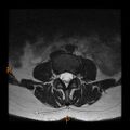 Normal spine MRI (Radiopaedia 77323-89408 Axial T2 8).jpg