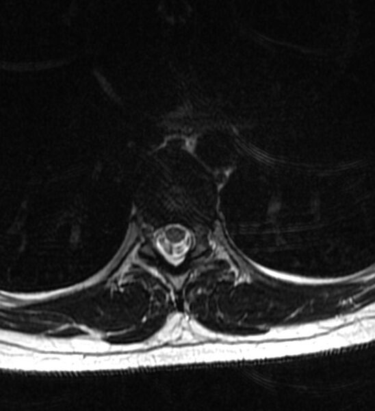 File:Normal thoracic spine MRI (Radiopaedia 41033-43781 Axial T2 8).jpg