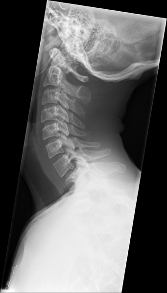 File:Normal trauma cervical spine (Radiopaedia 41017-43761 Lateral 1).png