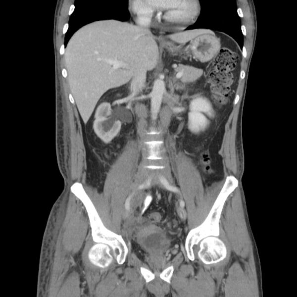 File:Obstructive bladder transitional cell carcinoma (Radiopaedia 9825-10410 B 11).jpg