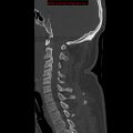 Occipital condyle fracture (Radiopaedia 18366-18208 Sagittal bone window 15).jpg