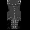 Occipital condyle fracture (Radiopaedia 31755-32691 Coronal bone window 26).jpg