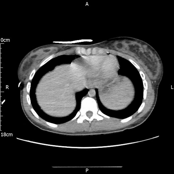 File:AAST grade IV kidney injury with CEUS follow-up (Radiopaedia 72353-82877 Axial C+ portal venous phase 6).jpg