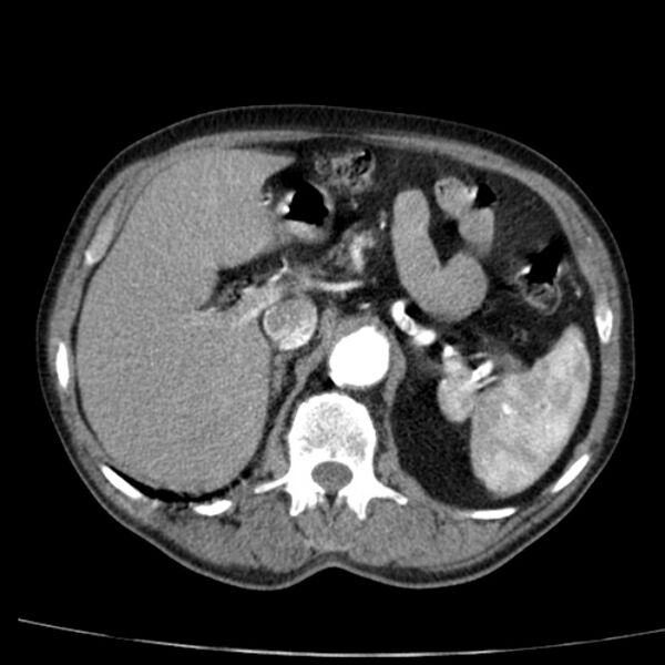File:Abdominal aortic aneurysm (Radiopaedia 29248-29660 Axial C+ arterial phase 22).jpg