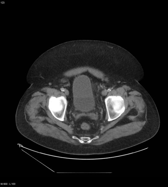 File:Abdominal aortic aneurysm with intramural hematoma then rupture (Radiopaedia 50278-55631 Axial C+ arterial phase 114).jpg