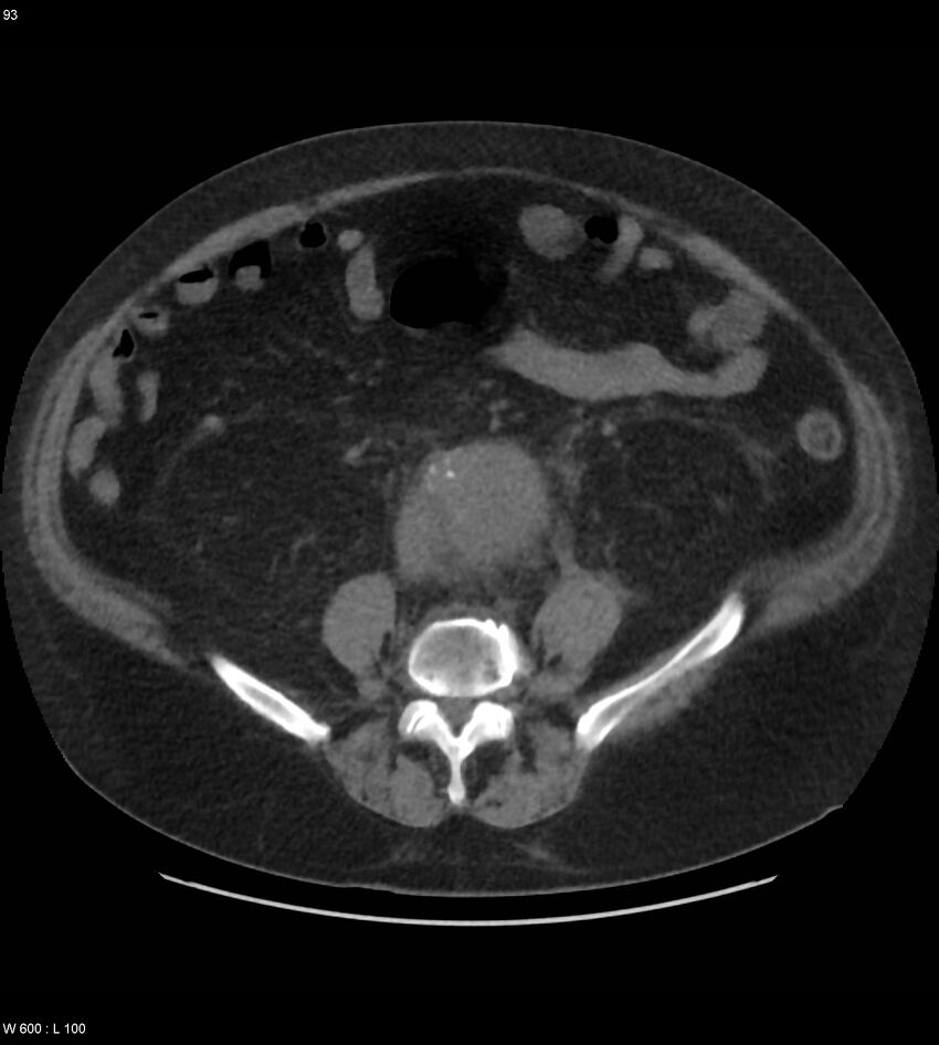 Abdominal aortic aneurysm with intramural hematoma then rupture (Radiopaedia 50278-55631 Axial non-contrast 89).jpg