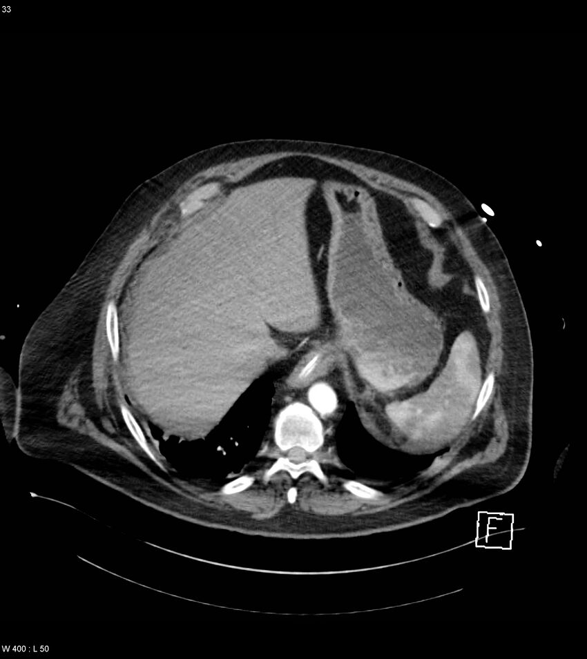 Abdominal aortic aneurysm with intramural hematoma then rupture (Radiopaedia 50278-55632 Axial C+ arterial phase 32).jpg