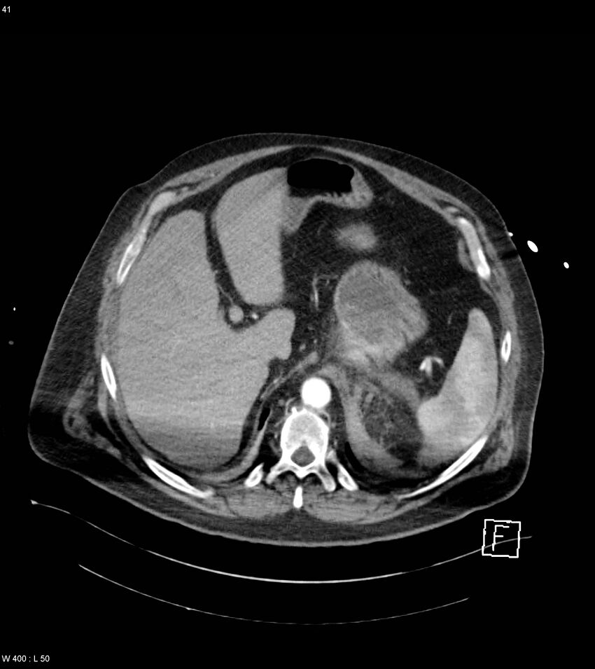 Abdominal aortic aneurysm with intramural hematoma then rupture (Radiopaedia 50278-55632 Axial C+ arterial phase 40).jpg