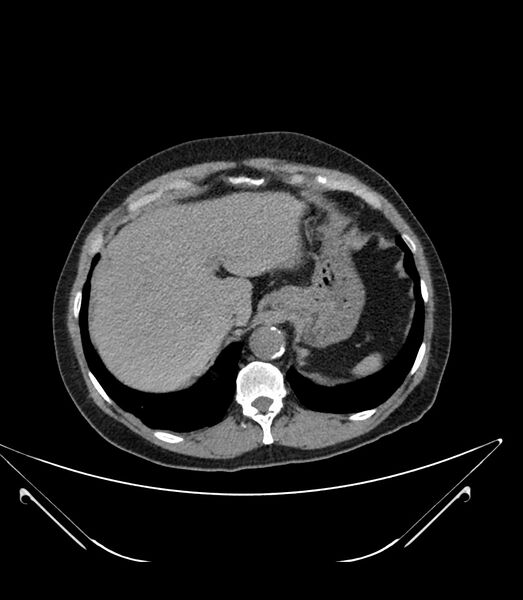 File:Abdominal aortic aneurysm with thrombus fissuration (Radiopaedia 46218-50618 Axial non-contrast 9).jpg
