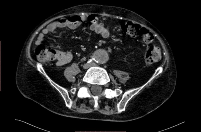 File:Abdominal aortic interposition tube graft and aneurysm thrombosis (Radiopaedia 71438-81857 Axial C+ arterial phase 129).jpg