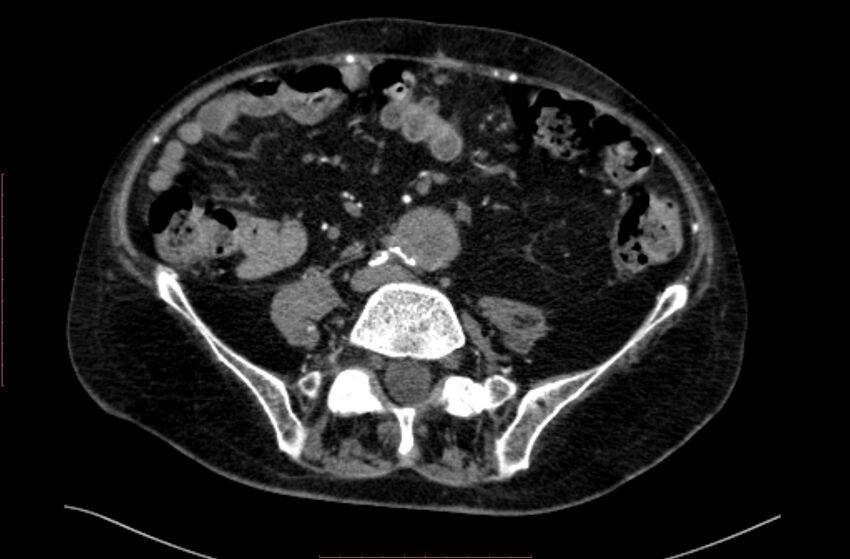 Abdominal aortic interposition tube graft and aneurysm thrombosis (Radiopaedia 71438-81857 Axial C+ arterial phase 129).jpg