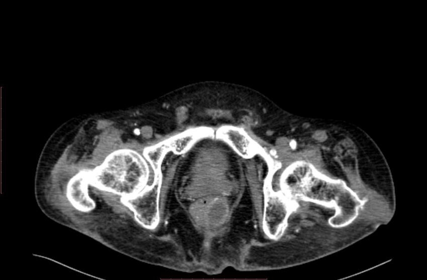 Abdominal aortic interposition tube graft and aneurysm thrombosis (Radiopaedia 71438-81857 Axial C+ arterial phase 242).jpg