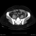 Abdominal wall endometriosis (Radiopaedia 25723-25885 Axial C+ portal venous phase 26).jpg