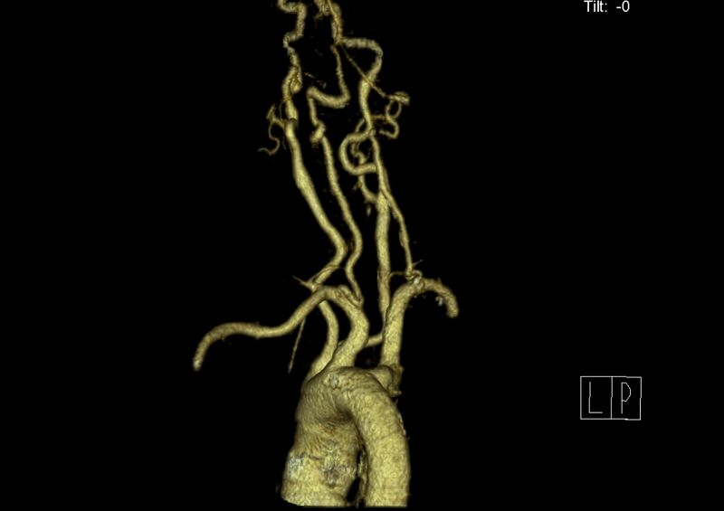 File:Aberrant right subclavian artery (Radiopaedia 19283-19294 3D reconstruction C+ arterial phase 18).jpg