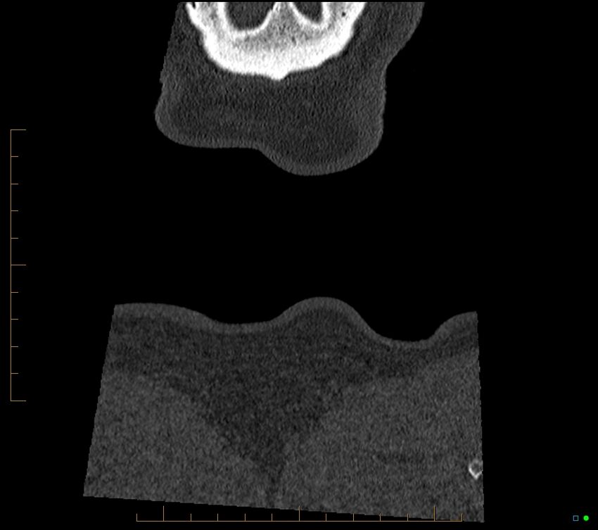 Accessory articulation of cervical transverse processes (Radiopaedia 82715-96933 Coronal non-contrast 141).jpg